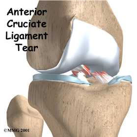 Anterior cruciate ligament tear